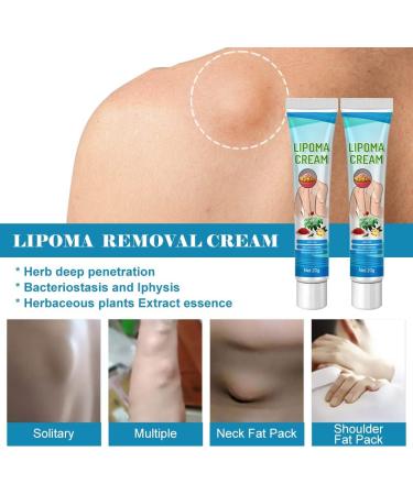 Buy FENGYANG 2PCS Lipoma Removal Cream - Herbal Solution for Lipom Lumps & Lymphatic Detox - Buy Online on GoSupps.com