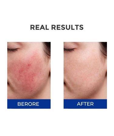 Hyaluronic Acid Repair Serum for Calming Barrier Repair Redness Reilef, for Sensitive Skin +4D Hyaluronic Acid Serum with VB5, Ceramides, Anti-Aging Hydrating for Moisturizing Barrier Daily face Care - Buy Online on GoSupps.com