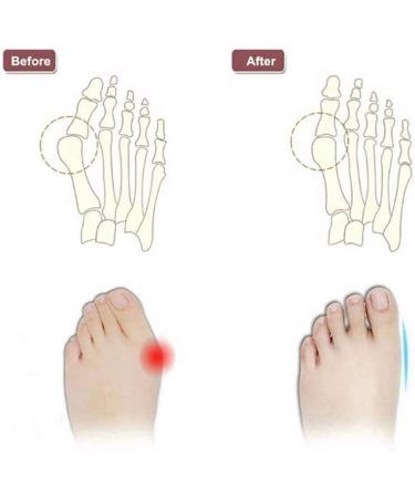 Big Toe Hallux Valgus Correction Sandals for Women - Bunion Splints for Pain Relief - Beige - Size 7 - Buy Online on GoSupps.com