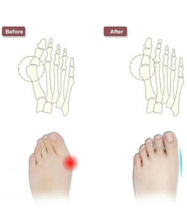 Summer Bunion Corrector Sandals for Women | Pain Relief Hallux Valgus | PU Leather Open Toe (Champagne Size 5.5 - Buy Online on GoSupps.com