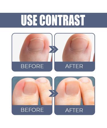  LWuuywa German Toenailplus Anti-Paronychia Relief Oil 10ml Correction Treatment Oil Nail Care Nail Growing Anti-Paronychia Aid Oil Ingrown Nail Drops - Buy Online on GoSupps.com