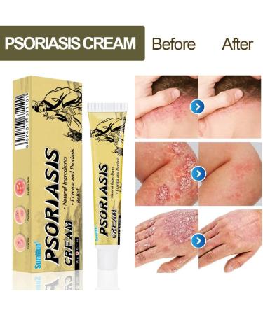 Sumifun Psoriasis Cream | Moisturizing Eczema & Anti-Itch Treatment | Dermatitis, Shingles, & Acne Relief | Natural Ingredients | 5 Pack - 0.71 oz - Buy Online on GoSupps.com