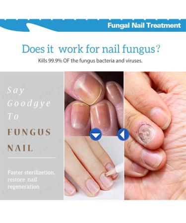 Nail Regeneration Bio-Pen 2Pcs Set for Effective Fragile Nail Repair - Men Women (Blue) - Buy Online on GoSupps.com