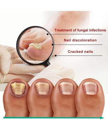 ZZBD 30ML-Kerassentials Toenail Fungus Treatment Oil Kerassentials Nail Treatment Kerassentials for Toenail Fungus for Healthy Natural Repair Nails-3pcs - Buy Online on GoSupps.com