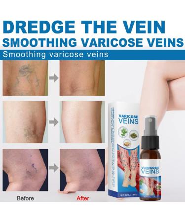 Varicose Veins Cream - Lichengtai Miracle Spray for Varicose & Spider Veins Relief - 3 Pack (20g) - Fast Muscle Soreness Relief - Buy Online on GoSupps.com