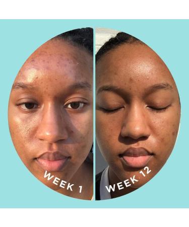 ZitSticka Blur Potion: Vitamin Supplement for Hyperpigmentation, Melasma & Dark Spots - 30 Caps - Buy Online on GoSupps.com