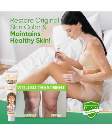 Natural Vitiligo Treatment Cream - Improve Skin Pigmentation & Reduce White Spots | Works on All Skin Types - Buy Online on GoSupps.com