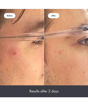 Hero Cosmetics Rescue Balm - Post Blemish Recovery Cream 15 ml | Soothes & Heals - Buy Online on GoSupps.com