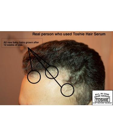 Toshie Regrowth Hair Serum - 5% Minoxidil Pumpkinseed & Rosemary Oil | Stops Hair Loss & Strengthens Hair for Men & Women - Buy Online on GoSupps.com