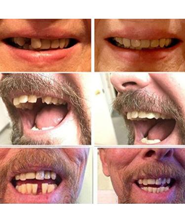 3-Part Temporary Dentures Set - Quick Tooth Replacement for Men & Women | Easy Thermal Repair Solution - Buy Online on GoSupps.com