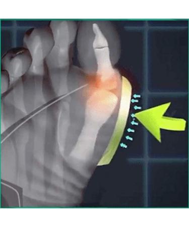 Comfortable Orthopedic Sandals for Women - Summer Comfy Flat Sole Bunion Corrector with Metal Buckle & Arch Support - Open Toe Design - Size 8 Brown - Buy Online on GoSupps.com