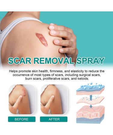 ZRRCYY Scar Remove Advanced Spray for Acne & Surgical Scars - 2pcs - Buy Online on GoSupps.com