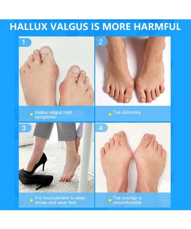 Xiongqi Silicone Toe Separators - 2 Pairs for Overlapping Toes & Bunions Relief | Toe Spacers & Smoothing Orthoses - Buy Online on GoSupps.com