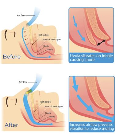 Lilivera Anti Snoring Devices - Silicone Magnetic Nose Clip (4 PCS) - Improve Sleep Quality - Buy Online on GoSupps.com
