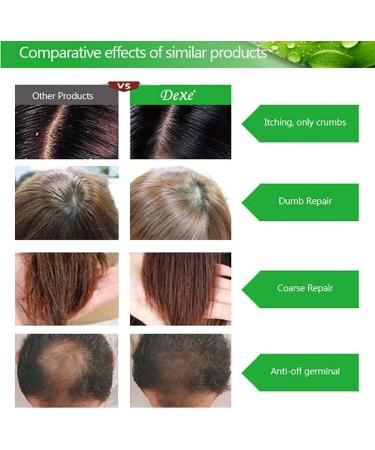 Lucoss Anti-Hair Loss Shampoo Improve Hair Quality Natural Herbal Extract Shampoo Best Hair Growth Shampoo Stimulates Hair Growth Helps Stop Hair Loss Grow Hair Fast Hair Loss Treatment. - Buy Online on GoSupps.com