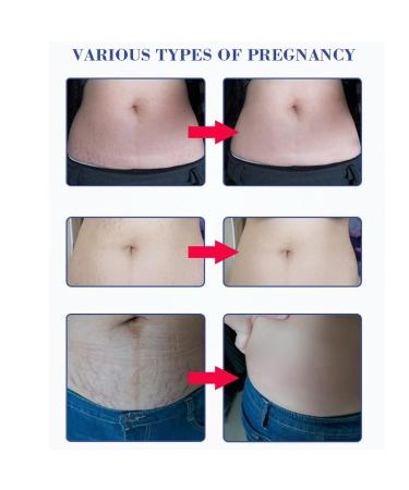 Stretch Strip Oil - Essential Massage Oil for Stretch Marks & Skin Care Treatment - Buy Online on GoSupps.com