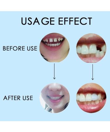 Dental Thermal Beads Teeth Veneers Moldable Dentures Temporary Tooth Repair 25g - Buy Online on GoSupps.com