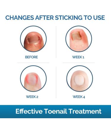 Ingrown Toenail Treatment - Painless Corrector Patch Strips with Nail Correction Tools | 50 Patches, Blue - Buy Online on GoSupps.com