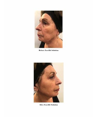 Dr. Sevinor Genuine Face Lift Solution - Plastic Surgery Alternative for All Skin Types - 4 fl. oz | International Shipping Available - Buy Online on GoSupps.com