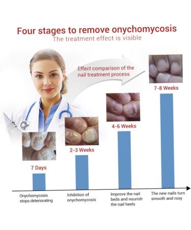 1PC Nail Treatment Nail Renewal Solution Toenails & Fingernails Nail Repairs Essential Oil Protects Toenail Fungus Treatment From Discoloration Brittle And Cracked Nail(12ML) - Buy Online on GoSupps.com