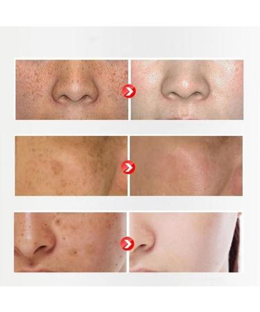  JIAOY 5 Pack Whitening Cream Anti Freckle Face Cream Spot Removal Moisturizer Lightening Face Concealer Anti Aging Cream - Buy Online on GoSupps.com