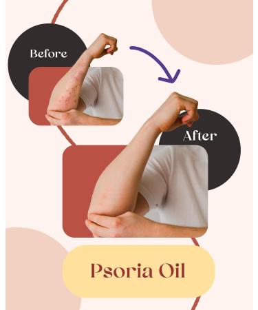 Psoria Oil - Ayurvedic Treatment for Natural Relief | 200 ml - Natural Ingredients for Psoriasis Care - Buy Online on GoSupps.com