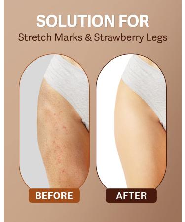 FOAMIST Vegan Arabica Coffee Body Scrub for Cellulite & Dark Spots - Exfoliate, Tone & Hydrate - 8.4oz - Buy Online on GoSupps.com