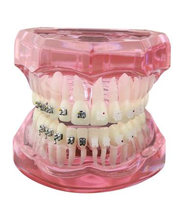 Orthodontics Model with Ceramic and Metal Brackets Teach Model