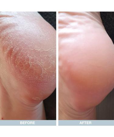 Cracked Heel Repair Cream 500ml | 25% Urea | Hard Skin Remover | Heel Balm for Dry Cracked Feet | Tea Tree Oil | Men & Women - 500.00 ml - Buy Online on GoSupps.com