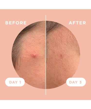 ZitSticka Killa Kit | Self-Dissolving Microdart Acne Pimple Patch for Blind, Early-Stage Zits | Spot Targeting for Face and Skin | 8 Pack - Buy Online on GoSupps.com