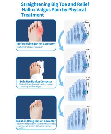 Buy Generic Bunion Corrector for Hallux Valgus - Adjustable Splint & Toe Straightener - Non-Slip Heel Strap - Day & Night Support - Buy Online on GoSupps.com