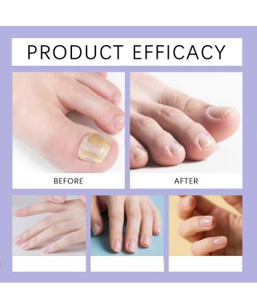 Renforce les ongles vitamine C huile de r paration des ongles pour les ongles ab m s cr me hydratante pour les ongles secs s rum de force pour les ongles fins et cassants (4pcs) - Buy Online on GoSupps.com