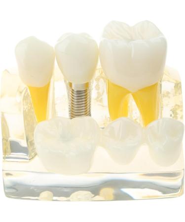 Implant Model Removable Bridge - Educational Teeth Model for Dental Studies | Perfect for Demonstration Classes - Buy Online on GoSupps.com