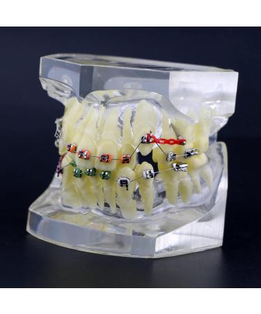 Orthodontic Tooth Model Orthodontic Dental Treatment Malocclusion Model with Brackets Chain Wire - Buy Online on GoSupps.com