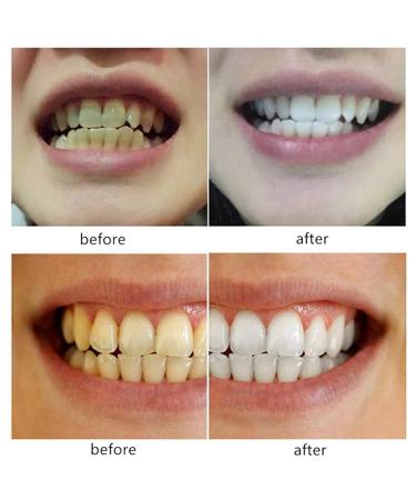 Buy 2 Pairs of Cosmetic Dentures - Veneer Prostheses | Fake Teeth for Men & Women - Perfect Smile Solution - Buy Online on GoSupps.com