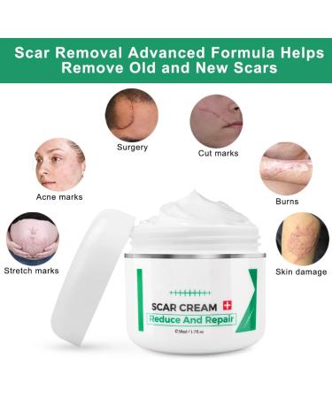 Aliver Scar Removal Cream - Stretch Mark & Acne Remover for Men & Women - Effective Treatment for Old & New Scars, Cuts, and Keloids - Buy Online on GoSupps.com