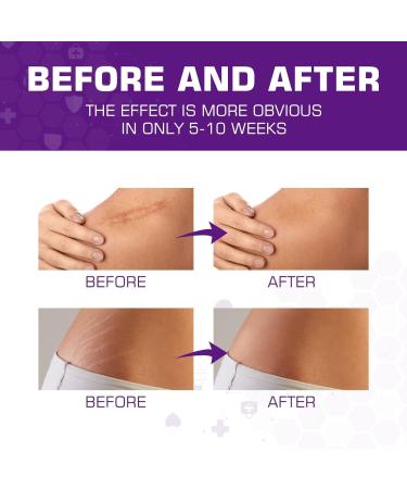 Scar Ointment & Gel | Effective Stretch Mark Removal | Scar Cream for Post-Surgery Care - Buy Online on GoSupps.com