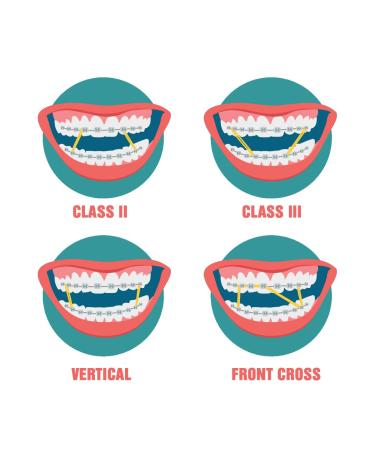 Orthodontic Intraoral Elastics - 1000pcs Extra Heavy 5/16" Surgical Latex - Made in USA | OrthodentalUSA Corp - Buy Online on GoSupps.com