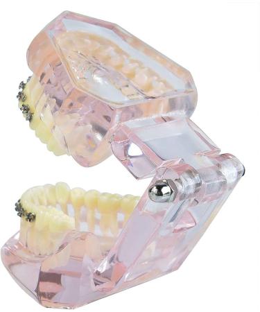 Dental Orthodontic Demonstration Model Dental Teeth Orthodontic Retainer Treatment Model with Metal Self-ligating Brackets Explaining Model - Buy Online on GoSupps.com