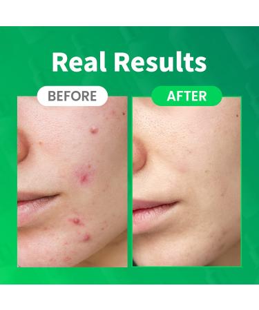 CRAZYSKIN Centella Tica Ampoule 1.7 fl. oz. - Redness Relief for Troubled Skin | Korean-Made Facial Serum - Buy Online on GoSupps.com