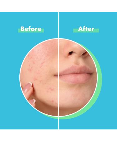 MedVance Advanced Hydrocolloid Acne Patches - Blemish & Zit Patches for Day and Night Use - Buy Online on GoSupps.com