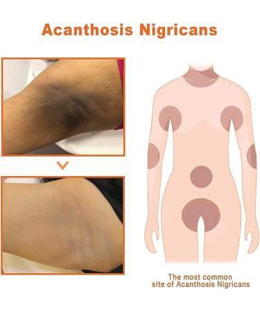 Anshka AcanthoGlow Therapy Cream Dark Knuckles Whitening Serum Dark Spot Corrector Oil Dark Knees and Elbows Strong Whitening Cream Body Black Skin 3 pieces - Buy Online on GoSupps.com