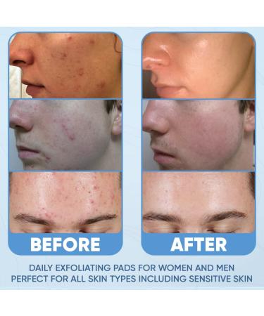 Salicylic Acid Acne Pads - Maximum Strength Peel for Clear Skin - 60 Count - Buy Online on GoSupps.com