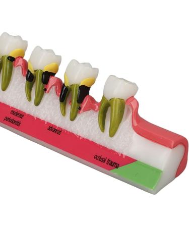 Dental Parodontitis Model - Visualize Stages & Improve Communication Between Dentists and Patients | International Shipping - Buy Online on GoSupps.com