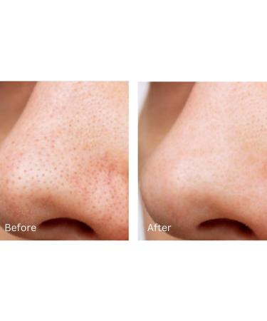 Clarifying Toner - Sweden s #1 BHA + PHA Exfoliating Facial Toner | Hydrating Toner with Hyaluronic Acid Green Tea & Tea Tree - 120ml - Buy Online on GoSupps.com