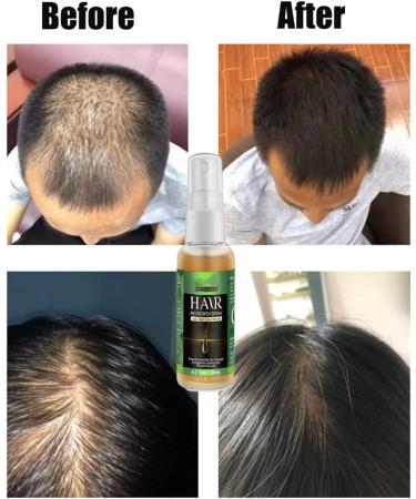  HADAVAKA Ginger Hair Growth Serum Hair Regrowth Spray Hair Growth Essential Oils Hair Serum Hair Nutrient Liquid Hair Conditioning Essential Oils Hair Growth Spray For Hair Care (1 pc) - Buy Online on GoSupps.com