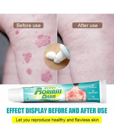 Eczema Honey Skin Care - Natural Chinese Herbal Anti-Itch Cream (Pack of 2) - Buy Online on GoSupps.com