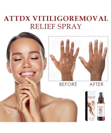 QIMIAN Vitiligo Removal Relief Spray - Skin Care Treatment for Reducing White Spots - 4Count (Pack of 4) - Buy Online on GoSupps.com