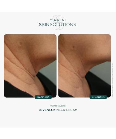Marini SkinSolutions Juveneck Neck Cream - Increases Hydration & Decreases Appearance of Uneven Texture Wrinkles & Discoloration with Peptides DMAE & Hyaluronic Acid - Made in the USA - 1.7 oz - Buy Online on GoSupps.com