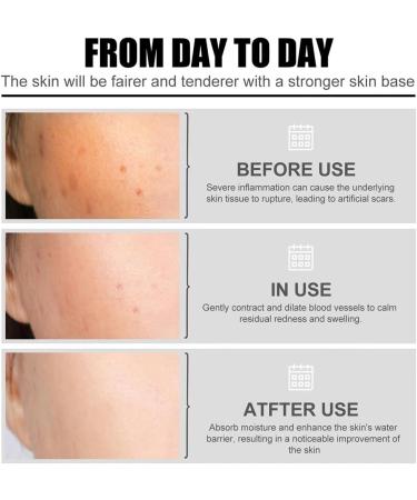 Niacinamide Freckles Removal Serum Niacinamide Spots Removal Serum Niacinamide Serum Nicotinamide Serum for Blemishes Niacinamide Serum for Face and Body for All Type Skin - Buy Online on GoSupps.com
